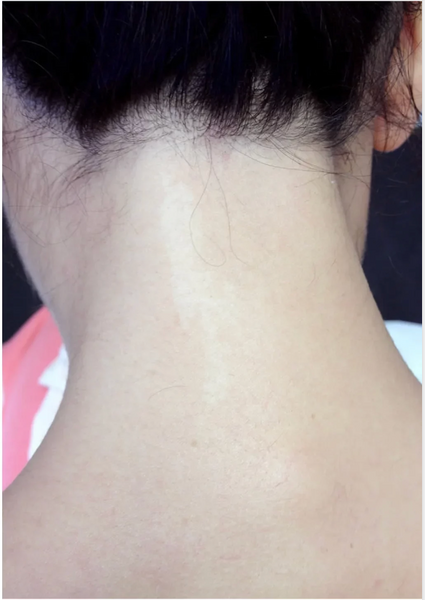 Neck Laser Hair Removal