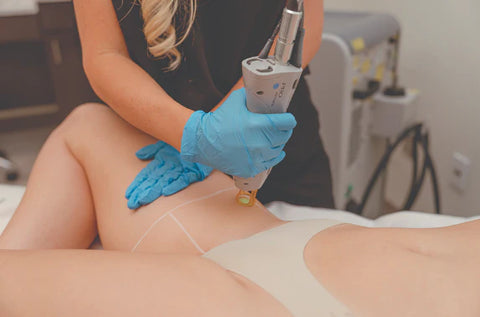Brazilian Laser
