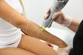 Full Arm Laser