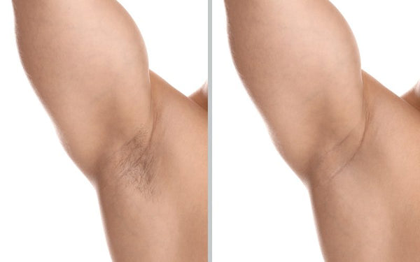 Underarm Laser for Him